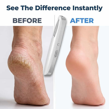 Electric Callus Remover