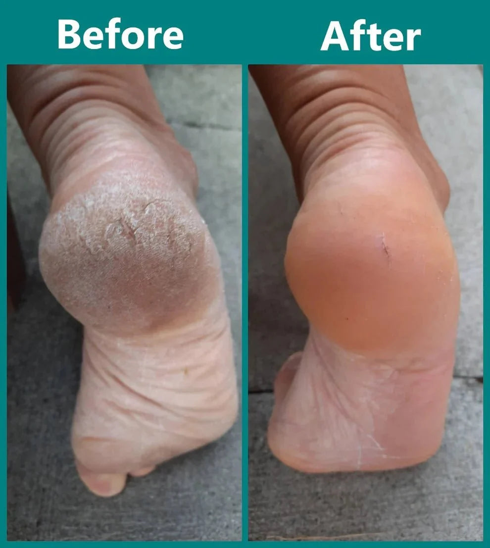Waterproof Dual-Roller Foot File